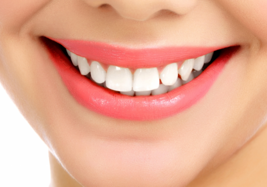 foto de sorriso com clareamento dental realizado na clinica sim
