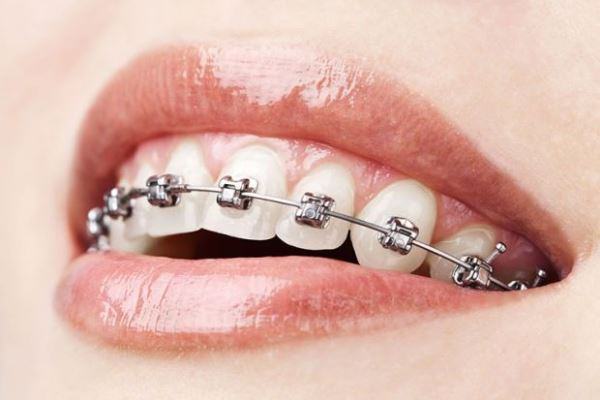 Aparelho dentário: dicas para aliviar as dores