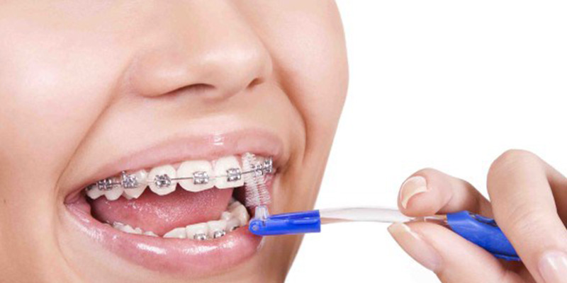 refer racket fiction 5 dicas de limpeza para quem usa aparelho dentário - Clínica SiM