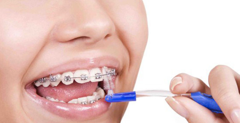 Foto de pessoa limpando aparelho dentário. dicas de limpeza de aparelho dentário