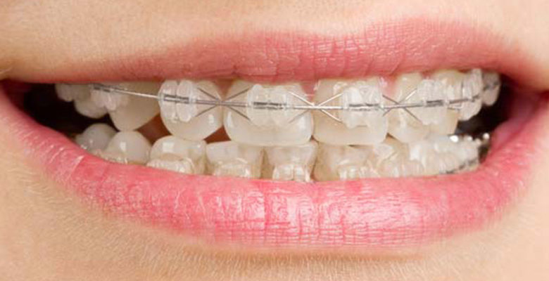 Foto de pessoa sorrindo com aparelho de dente.