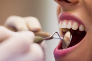 Dentista examinando os dentes de alguém com tártaro