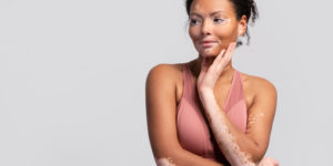 mulher com vitiligo