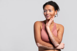 mulher com vitiligo